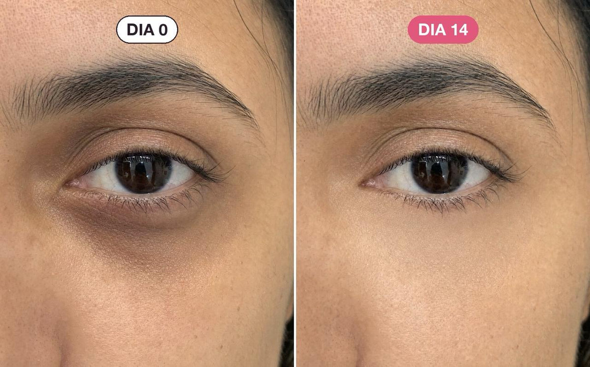 A área dos olhos de Renata no dia 0 e no dia 14