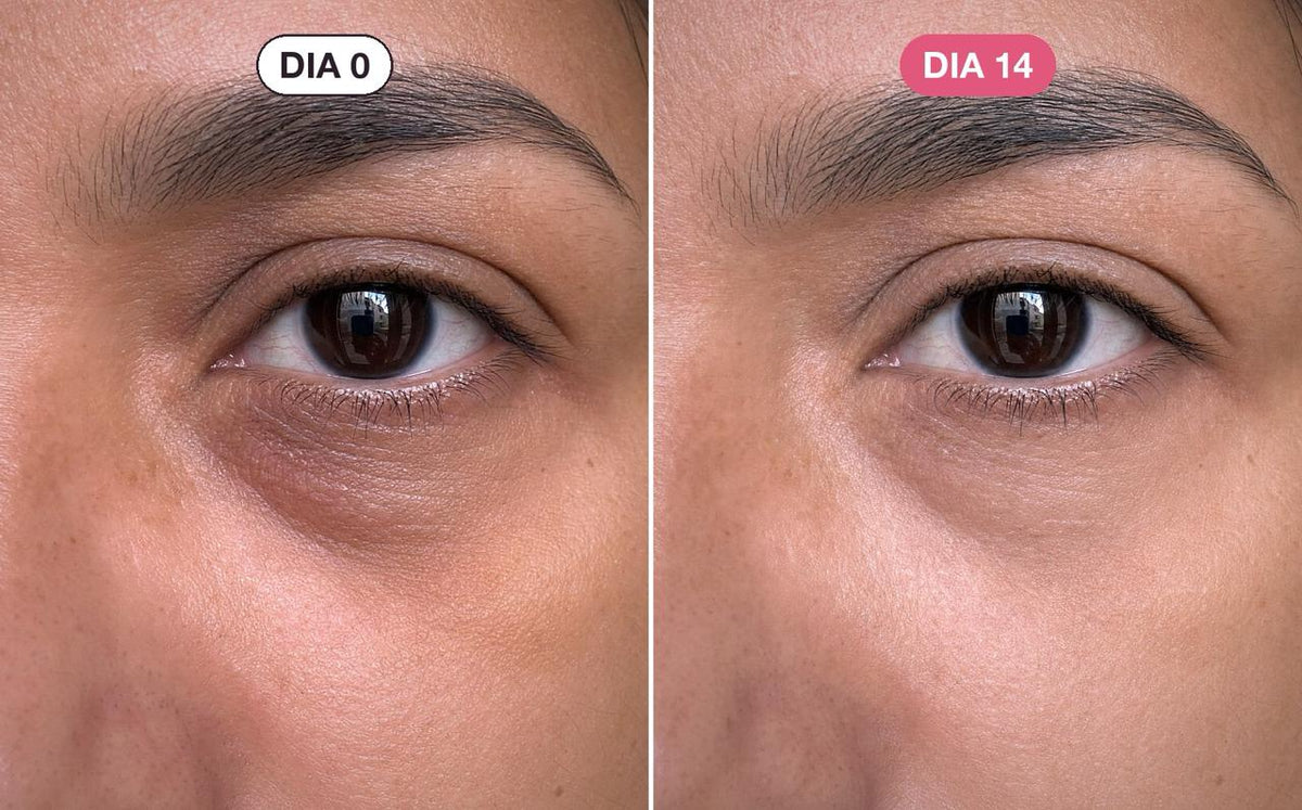 A área dos olhos de Janaína no dia 0 e no dia 14