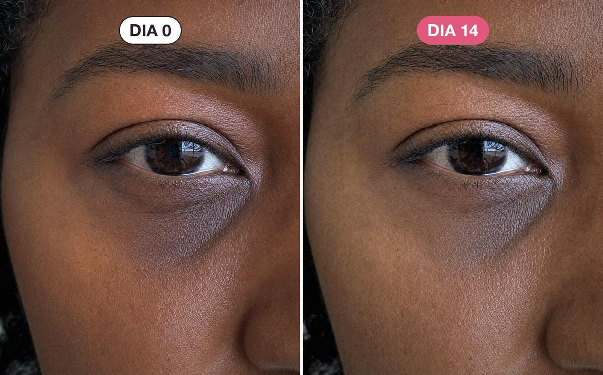 A área dos olhos de Lúcia no dia 0 e no dia 14