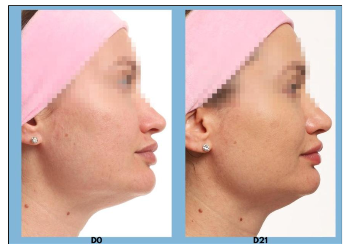 Teste in vivo do produto acabado, uma aplicação por dia. D0 / D21.