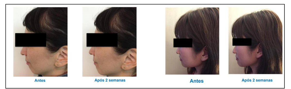 Melhora no V-Shape com 2% do ativo. Antes e após 2 semanas.