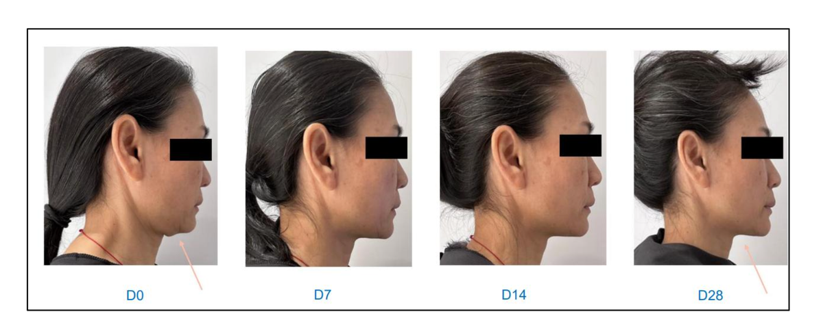 Melhora no V-Shape com 5% do ativo. D0 / D7 / D14 / D28.