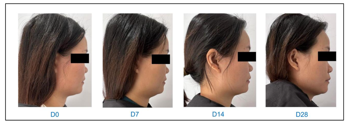 Melhora no V-Shape com 5% do ativo. D0 / D7 / D14 / D28.